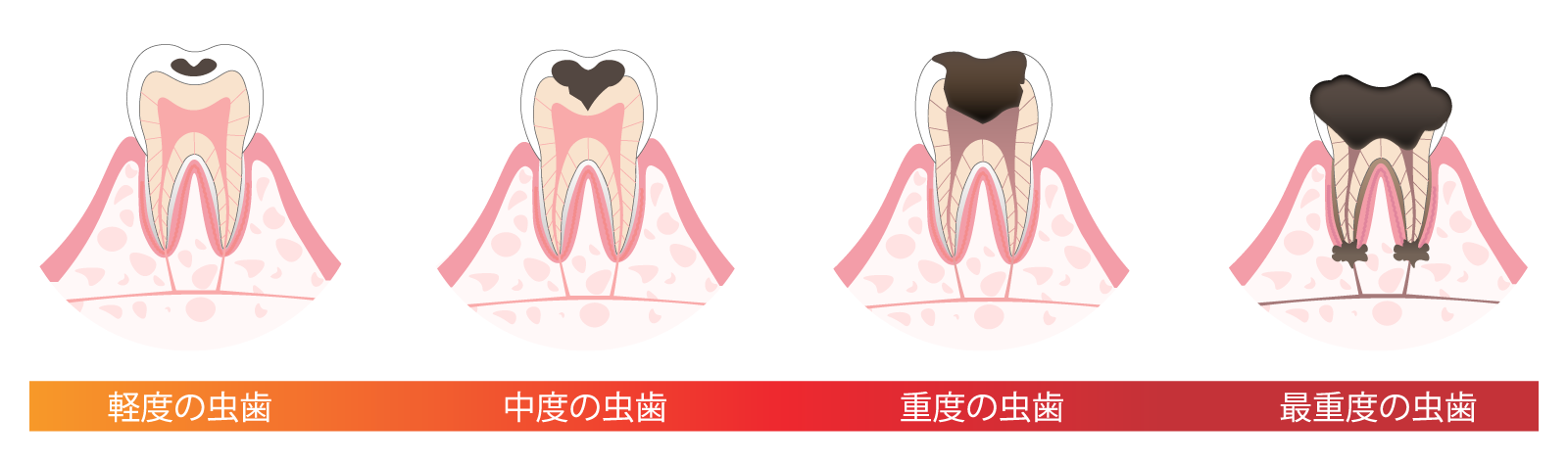 虫歯の進行
