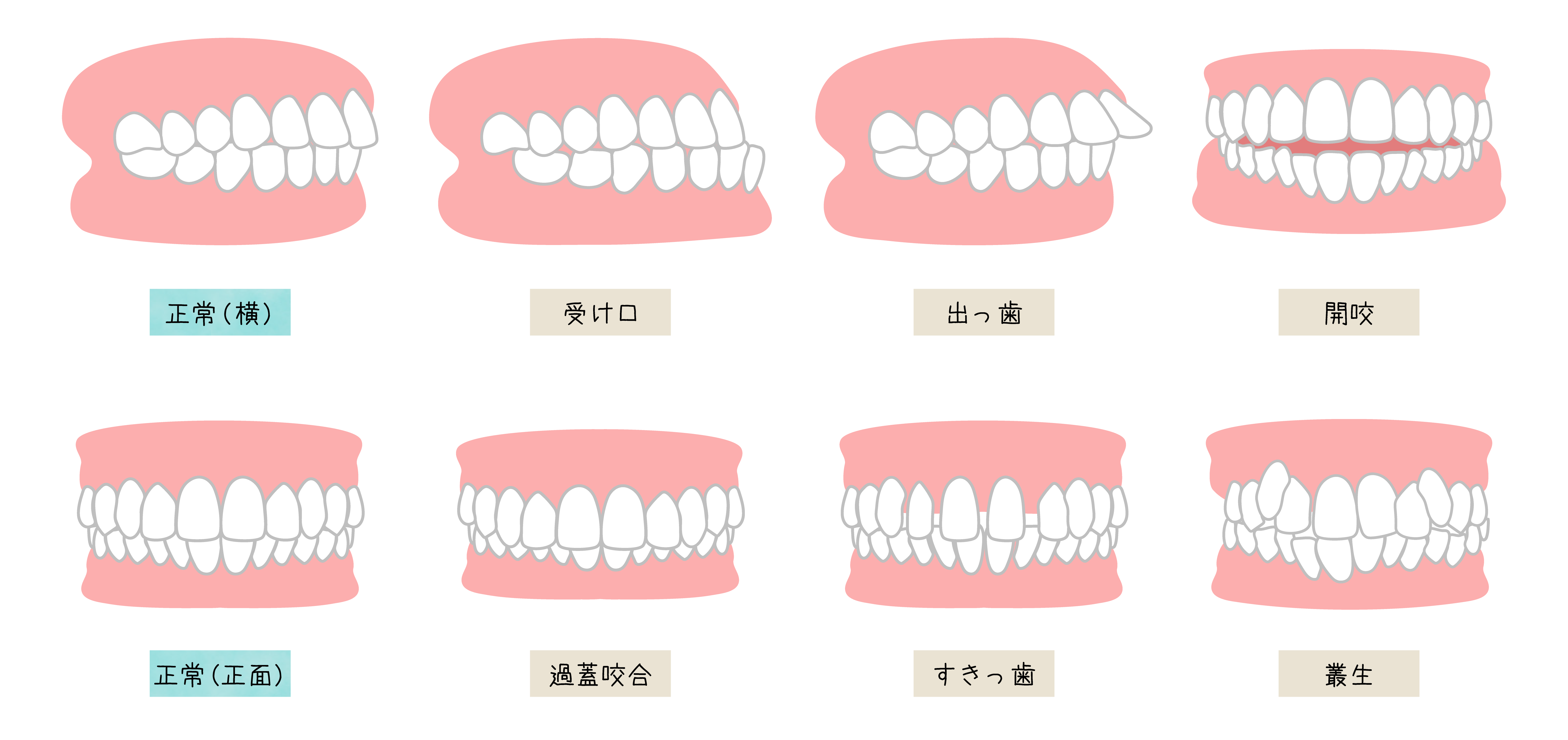 歯並びの種類
